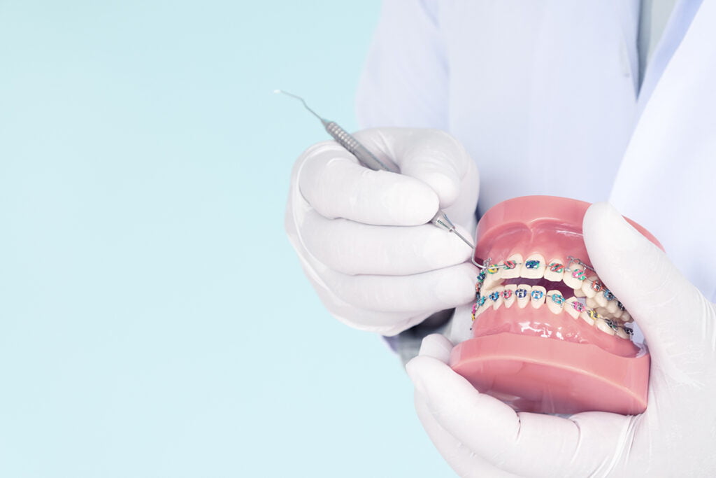orthodontic model and dentist tool - demonstration teeth model of varities of orthodontic bracket or brace